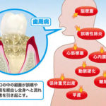 歯のメンテナンスと体のメンテナンス